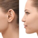 RHINOPLASTY RECOVERY